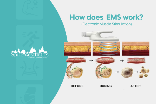 EMS treatment for post pregnancy weight loss treatment Hadleigh