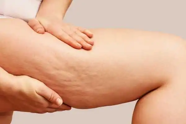 Image of woman showing leg with cellulite Hadleigh