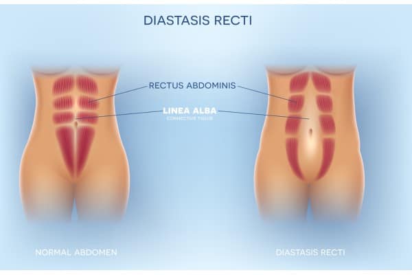 What Non-Surgical Options Are Available for Diastasis Recti Hadleigh?