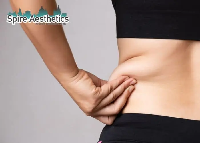 Image of woman pinching fat on their hips Hadleigh. Fat Freezing treatment