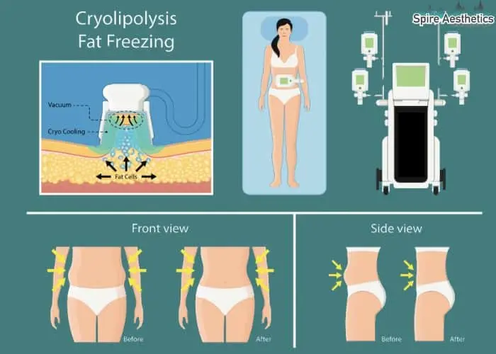 Fat freezing treatment Hadleigh benefits for competitions to remove stubborn fat deposits.