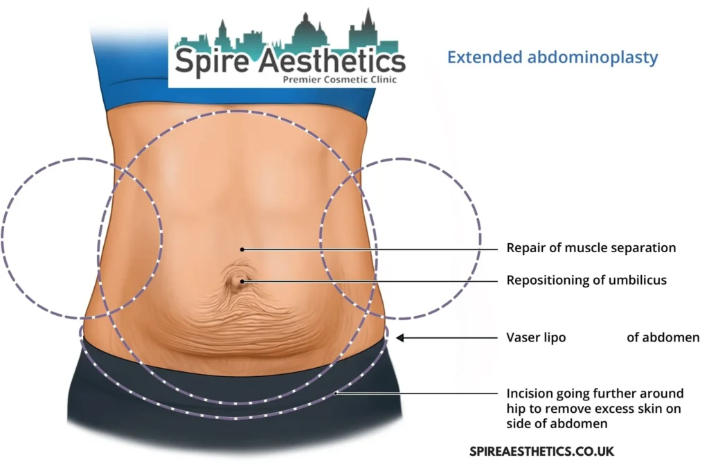 Understanding Loose Skin After Gastric Band Hadleigh Surgery and HIFU Treatment
