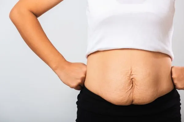 Image of a woman's stomach after weight loss with sagging skin following a gastric band Hadleigh