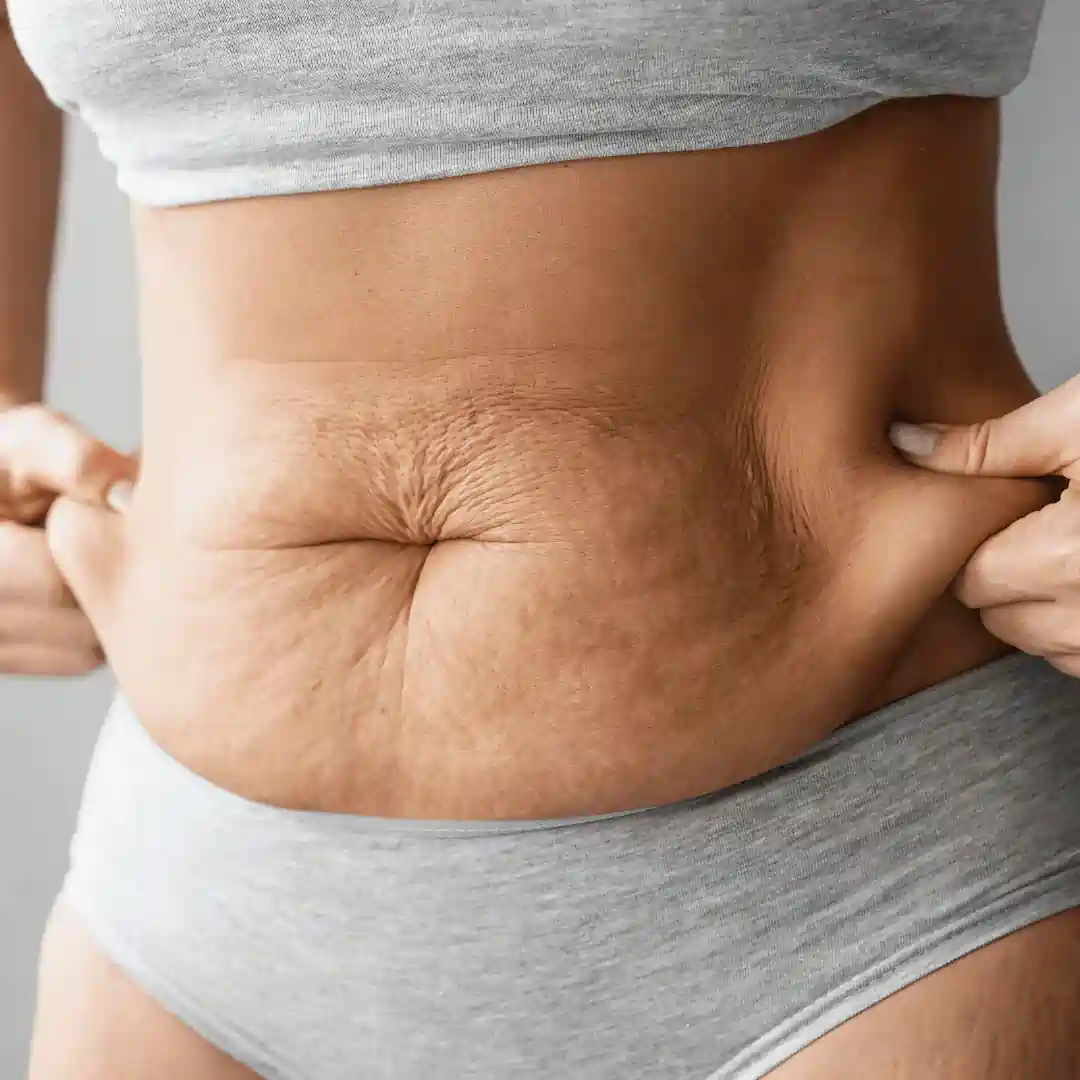 Is It Normal to Have Loose Skin After Pregnancy Hadleigh?