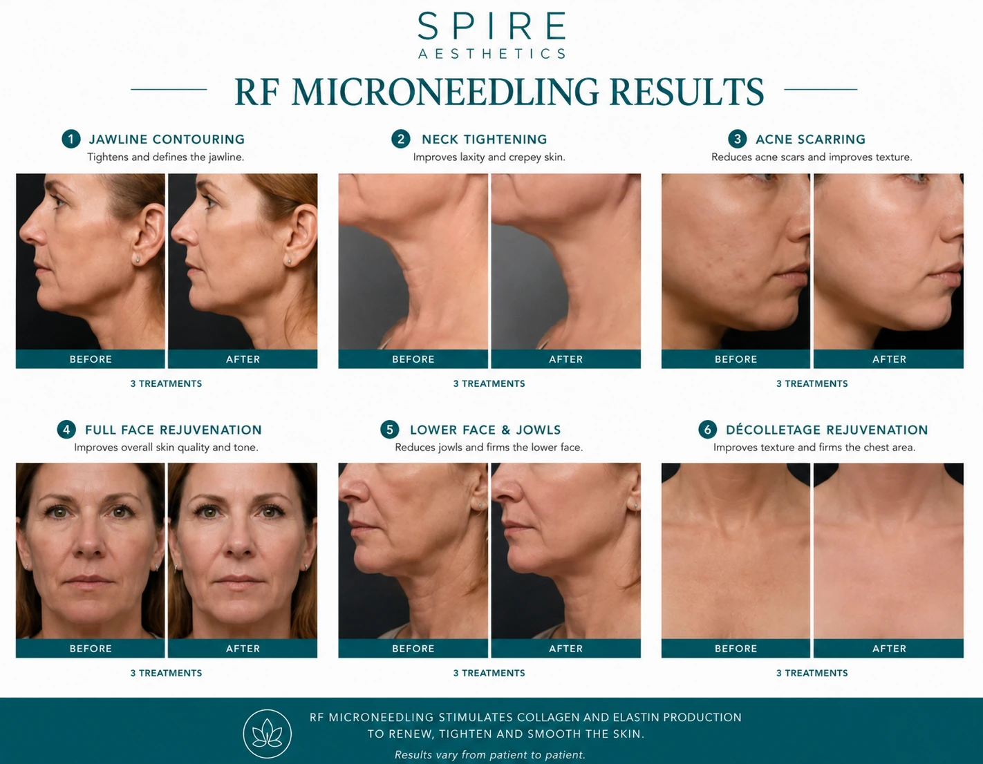 RF Microneedling Skin tightening Hadleigh results