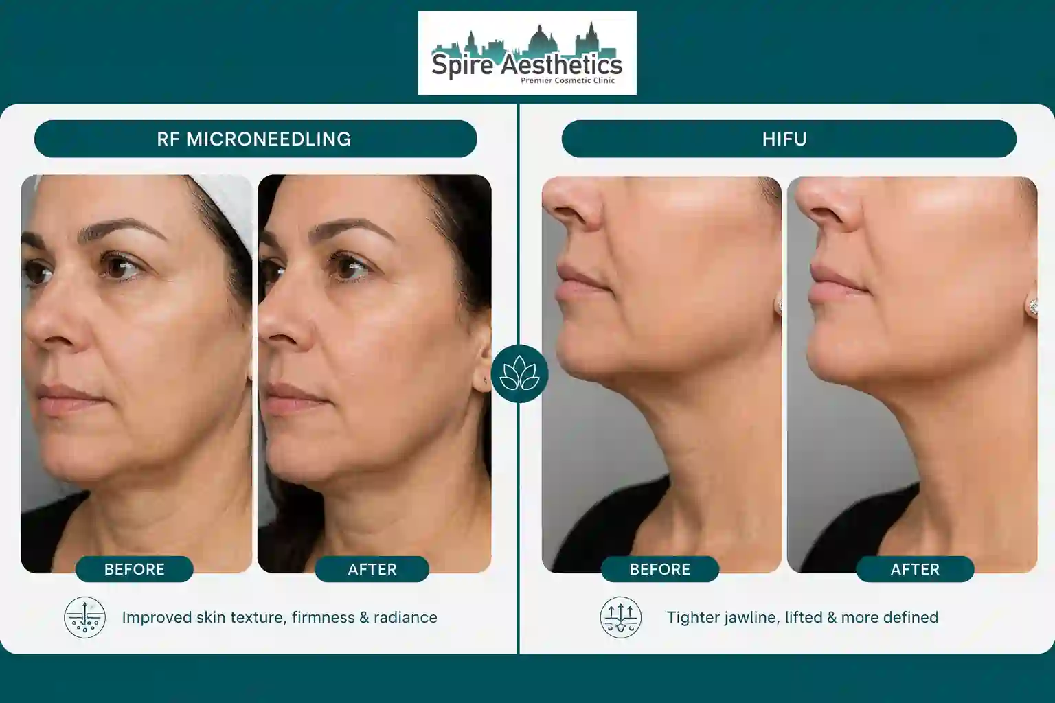 Can RF Microneedling and HIFU Be Combined Hadleigh?