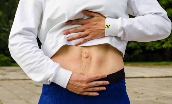 When Could Diastasis Recti Be the Missing Piece of the Puzzle Hadleigh?