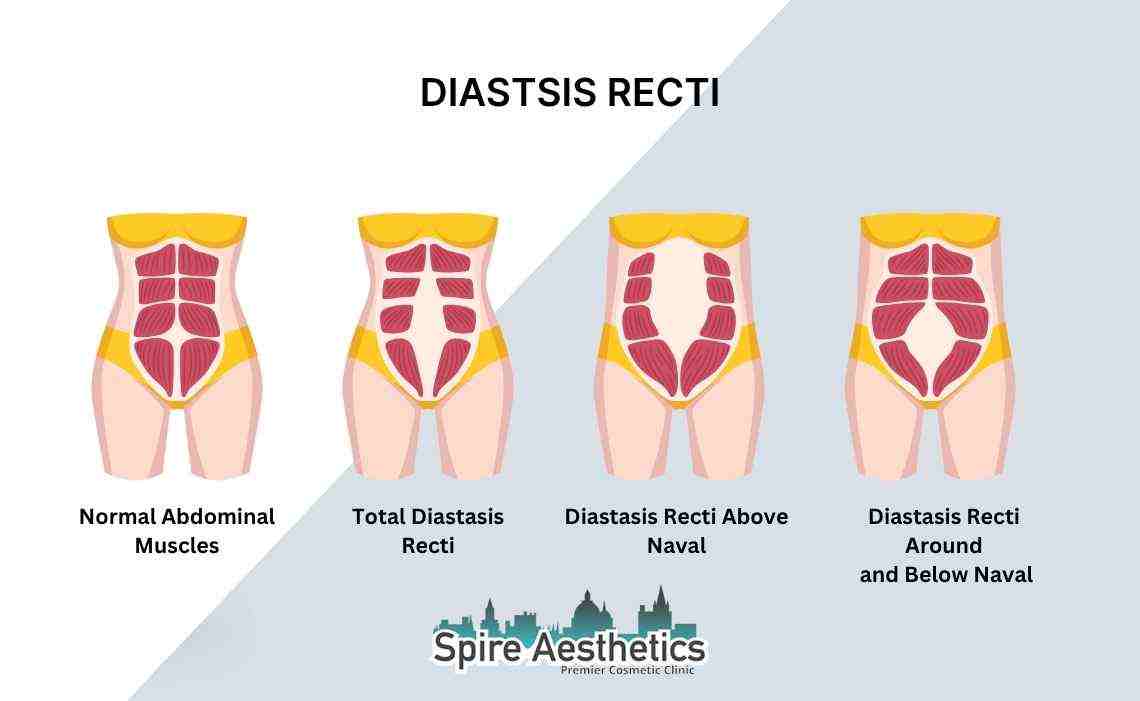Is Non-Surgical Diastasis Recti Treatment Right for You? Common Concerns Answered Hadleigh